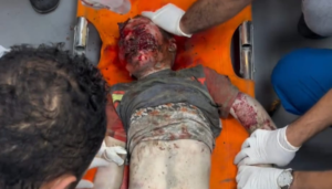 Immagine sensibile: bambino palestinese mutilato dai bombardamenti israeliani ancora vivo durante una operazione chirurgica